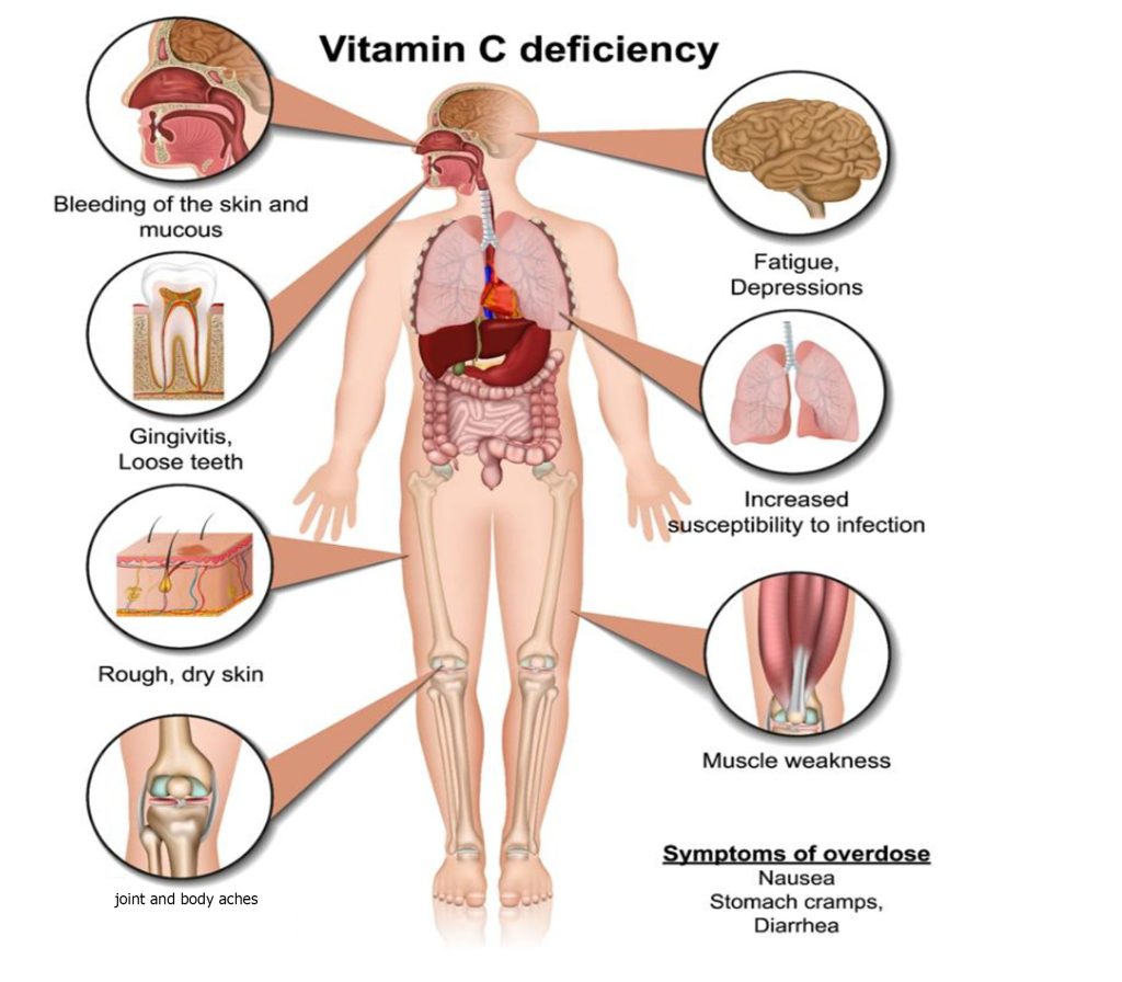 vitamine C deficiency